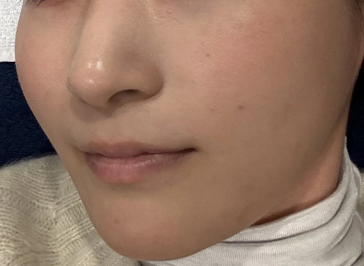 韓国で肌管理　施術前