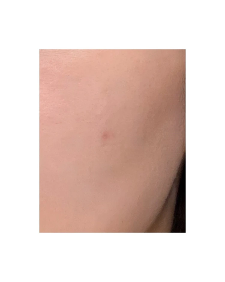 【2025年ベスト美容医療】美容オタクOLが選ぶ「アドバテックスレーザー」が“推せる”理由_5