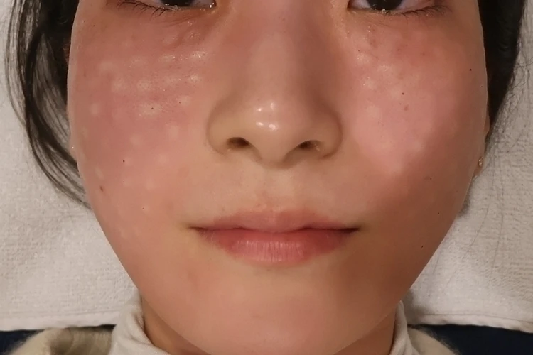 韓国で肌管理　リジュラン