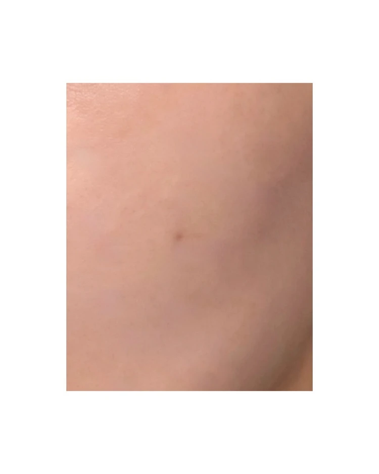 【2025年ベスト美容医療】美容オタクOLが選ぶ「アドバテックスレーザー」が“推せる”理由_7