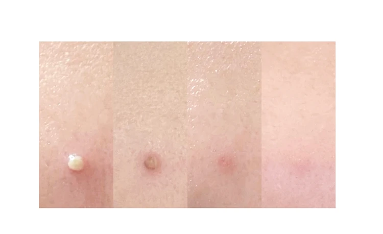 PAIRアクネクリームW、ニキビケア、市販薬レビュー、白ニキビ、赤ニキビ、肌荒れ対策、撮影前美容、おでこニキビ、スキンケアレビュー、美容体験談