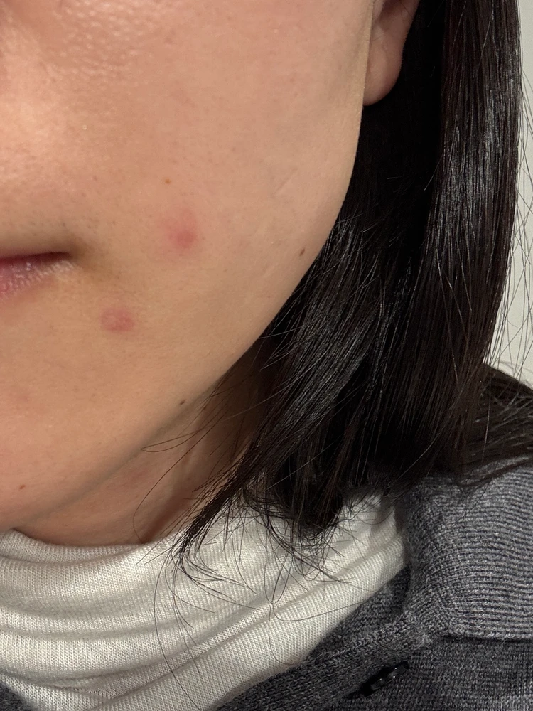 ニキビだと思って粉瘤を放置した結果…顔に跡が残った私の体験談_2