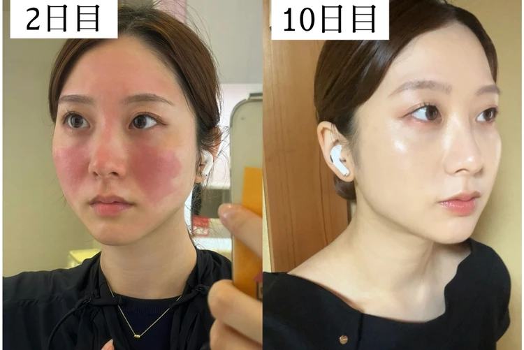 【写真】べピオローション使用後2日目 接触性皮膚炎