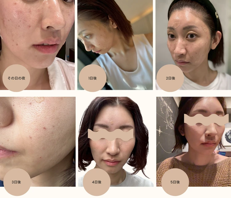 韓国美容旅レポ｜ラミチェクリニックで10施術体験記_17