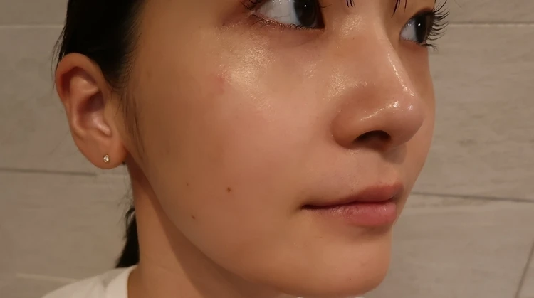 韓国で肌管理　施術して2週間後