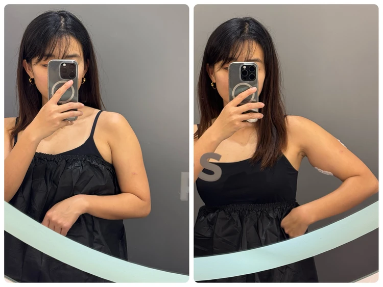 ペッ注射 ソウル 韓国美容 脂肪溶解