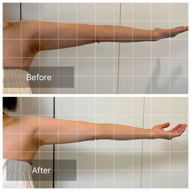 【体験レポ】注射なしで顔も腕もスッキリ！エステで受けるノンニードルレモンボトルが予想以上だった_2