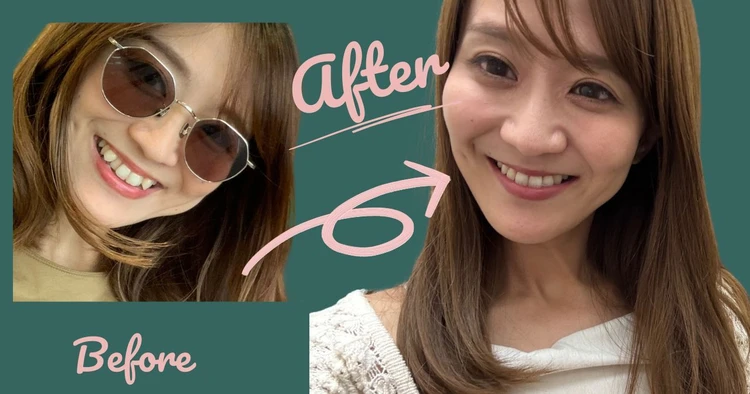 歯列矯正後のbefore and after