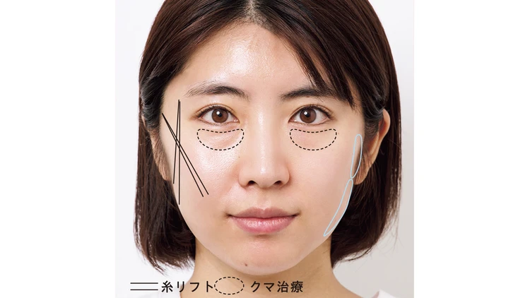 たるみケアに効く施術って?カウンセリング大公開!引き上げ「美容医療」勉強会