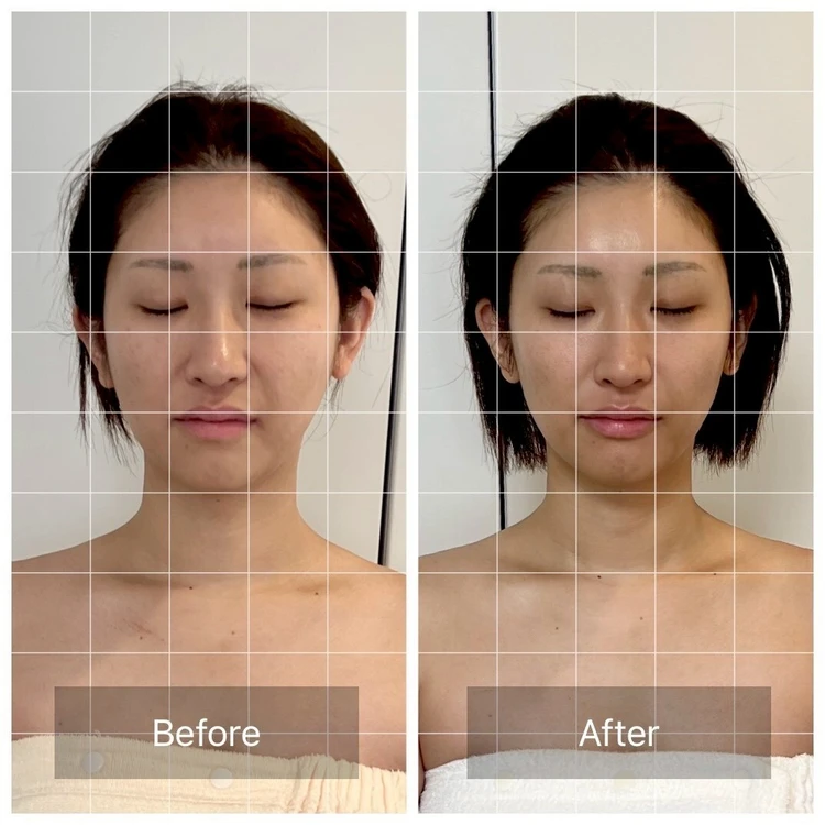 【体験レポ】注射なしで顔も腕もスッキリ！エステで受けるノンニードルレモンボトルが予想以上だった_4