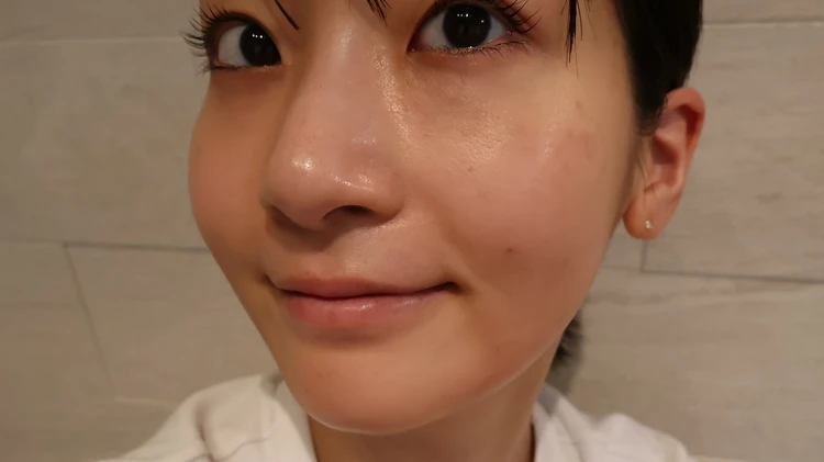 韓国で肌管理　施術して2週間後