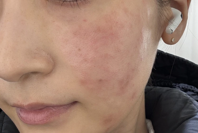 韓国で肌管理　リジュラン