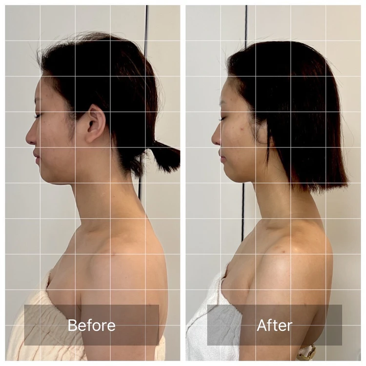 【体験レポ】注射なしで顔も腕もスッキリ！エステで受けるノンニードルレモンボトルが予想以上だった_3