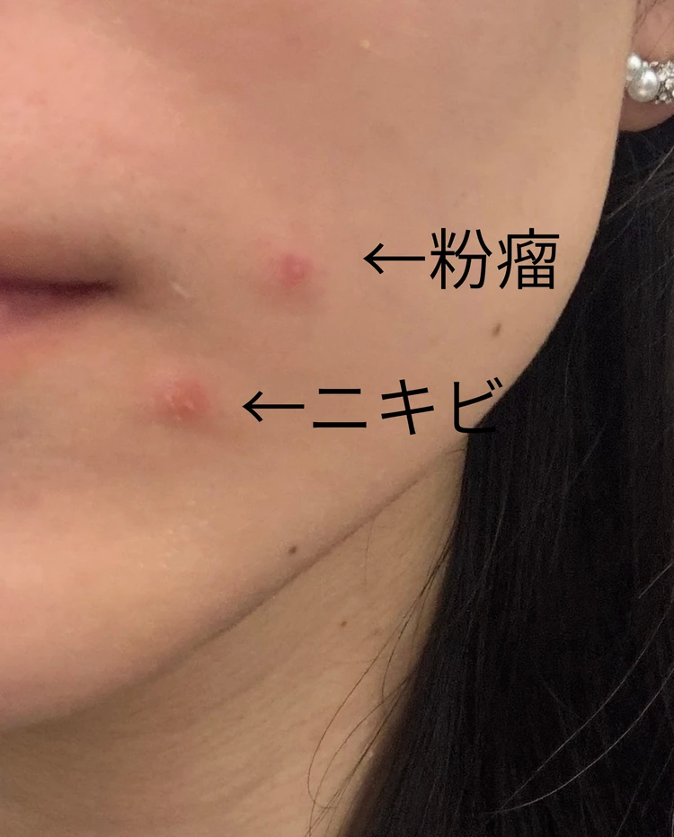 ニキビだと思って粉瘤を放置した結果…顔に跡が残った私の体験談_1