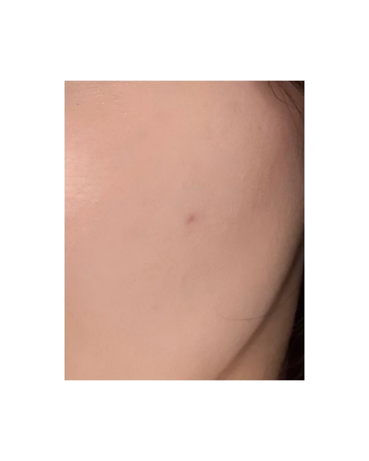 【2025年ベスト美容医療】美容オタクOLが選ぶ「アドバテックスレーザー」が“推せる”理由_6