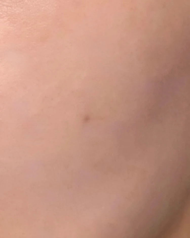 【2025年ベスト美容医療】美容オタクOLが選ぶ「アドバテックスレーザー」が“推せる”理由_8_2