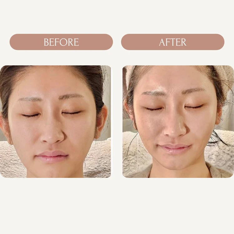 日本ではまだ珍しいのに、効果は桁違い。 最新の輪郭管理ケアを受けてきました_5