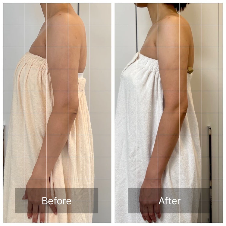 【体験レポ】注射なしで顔も腕もスッキリ！エステで受けるノンニードルレモンボトルが予想以上だった_1