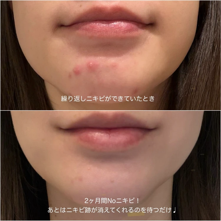 繰り返す「顎ニキビ」を克服！私がやめた3つのNGスキンケア_1