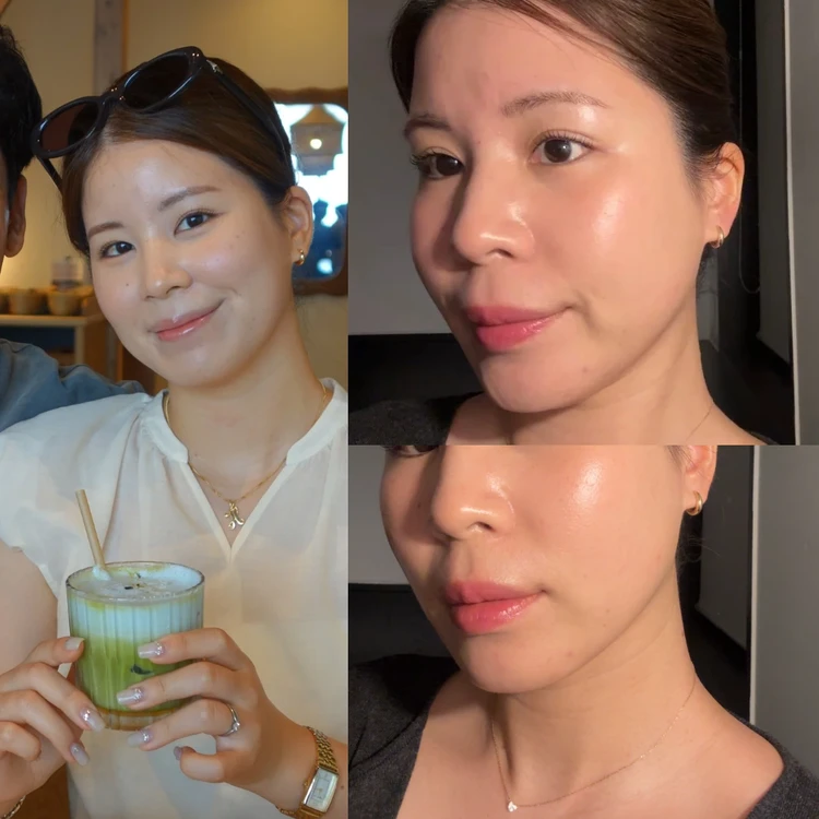 ルビーフラクショナル2回受けてみた｜シミ・トーンアップへの効果とリアルな感想_3