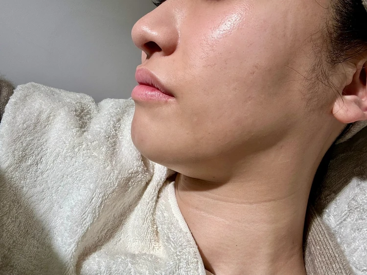 日本ではまだ珍しいのに、効果は桁違い。 最新の輪郭管理ケアを受けてきました_3