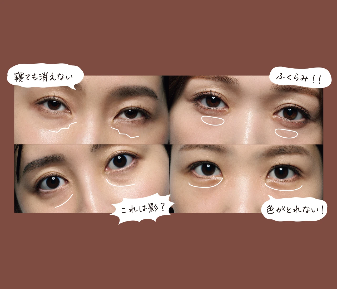 あなたの「クマ」の種類はどれ？美容のプロが指南！