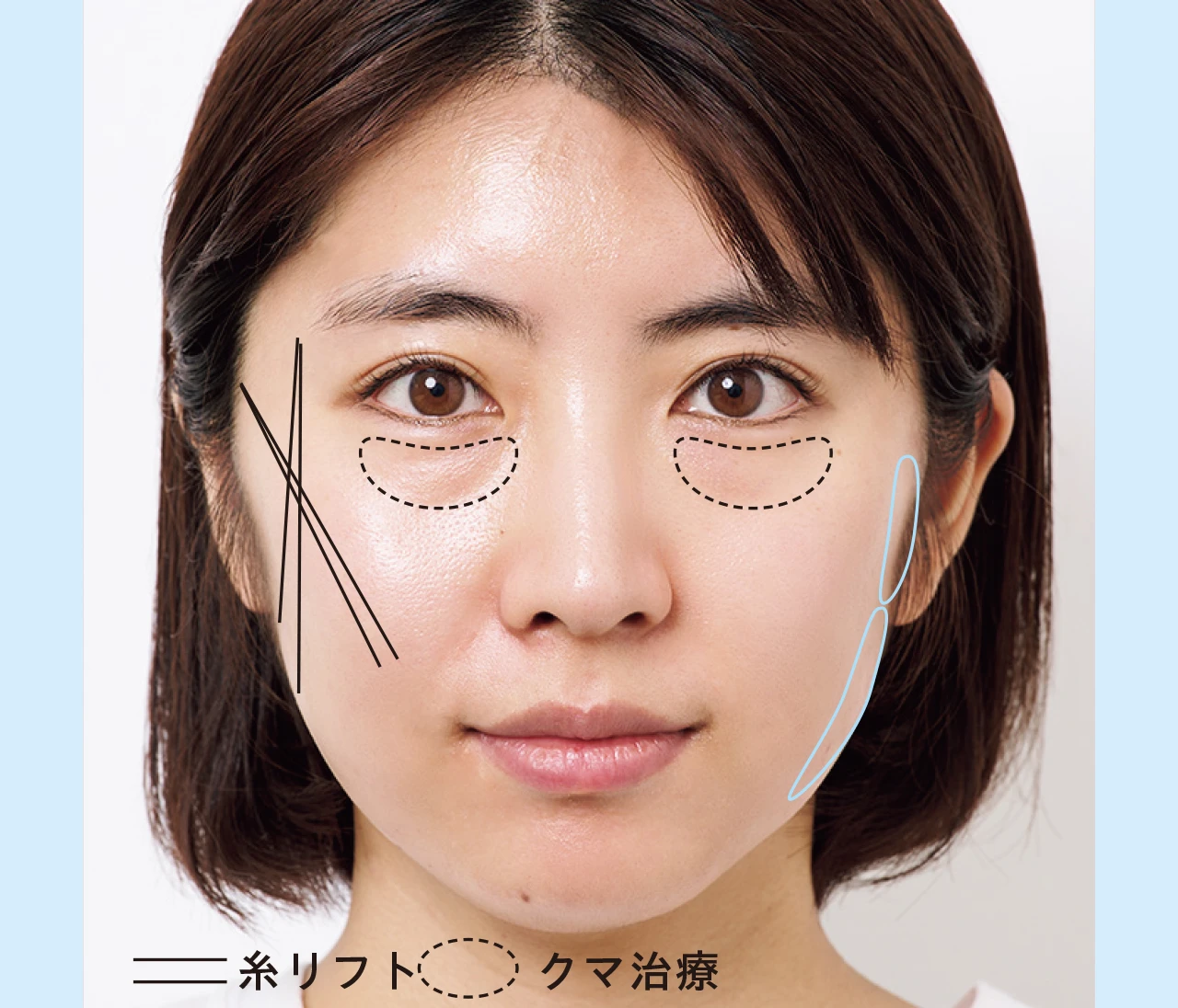 たるみケアに効く施術って?カウンセリング大公開!引き上げ「美容医療」勉強会