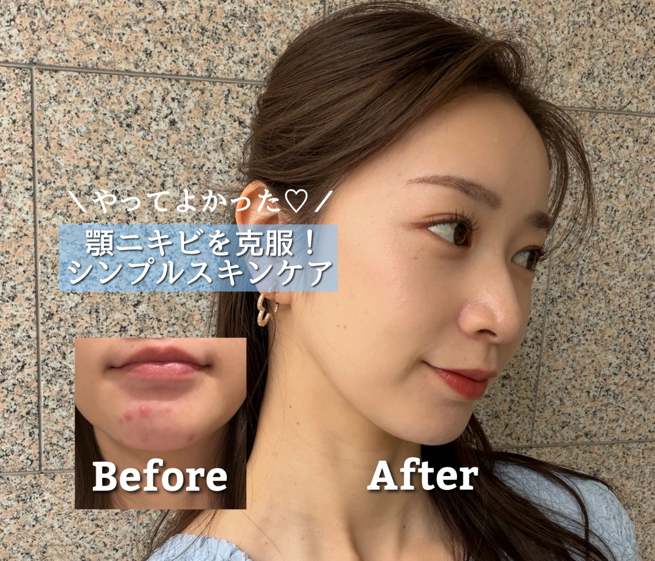 繰り返す「顎ニキビ」を克服！私がやめた3つのNGスキンケア