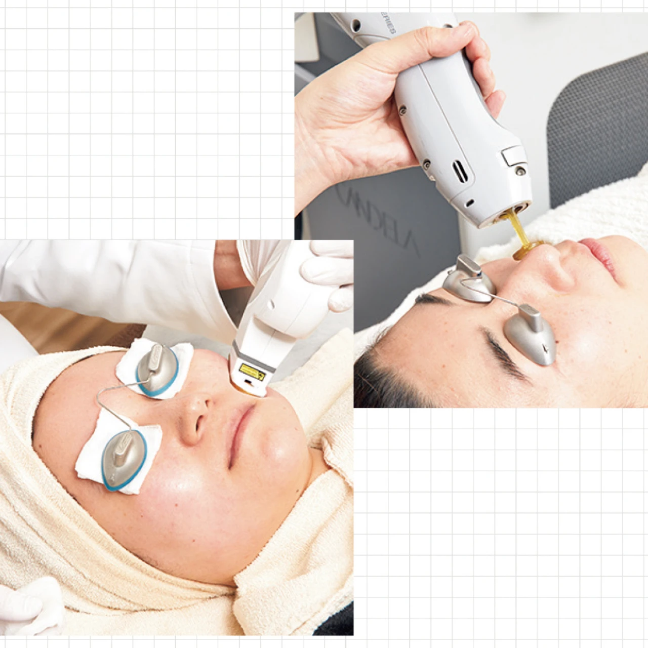 【毛穴対策 2025年最新】美容医療で毛穴悩みを撃退！ 黒ずみ毛穴、開き毛穴のおすすめ施術にトライ！