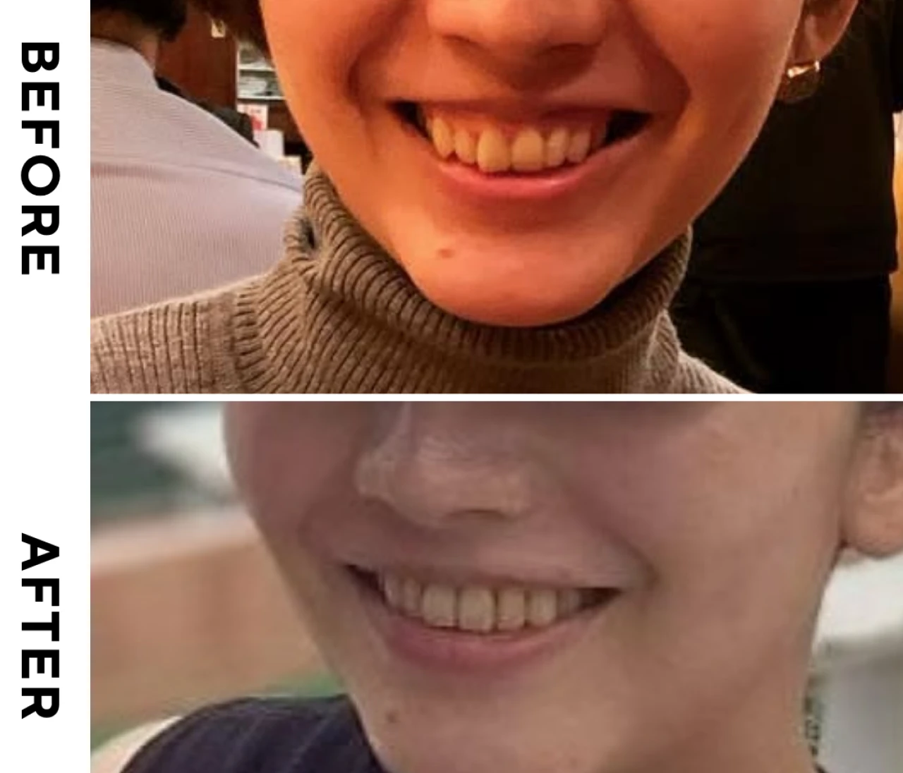 【Before/Afterあり】未来の自分への投資！歯列矯正のすゝめ