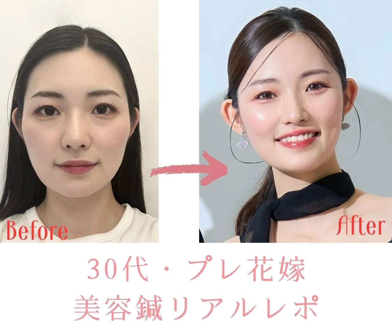 【顔、変わった？】30代・プレ花嫁の美容鍼リアルレポ