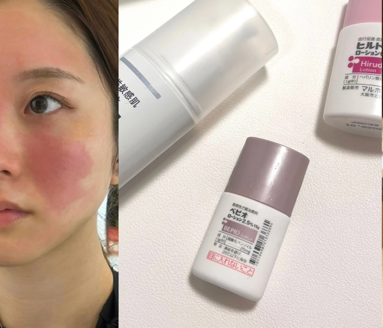 【体験レポ】皮膚科で処方してもらったニキビ治療薬【べピオローション】を使ってみた