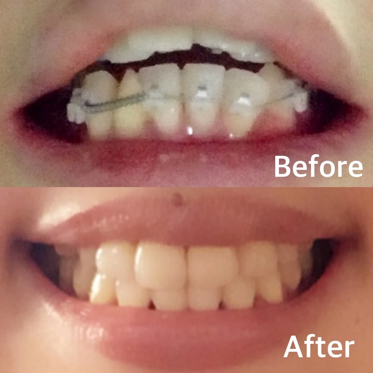 【大人の歯列矯正】アラサーの大事な4年を捧げた歯並び改善、全部見せます!①