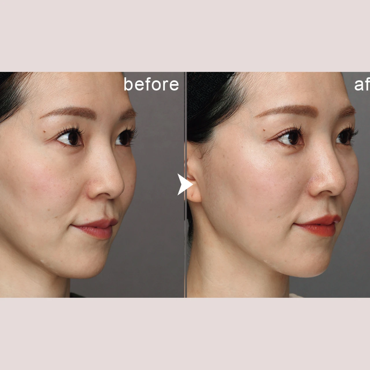 メイクやスキンケアではリカバリーできないクマに! “クマ取り手術”で気をつけるべき点は?