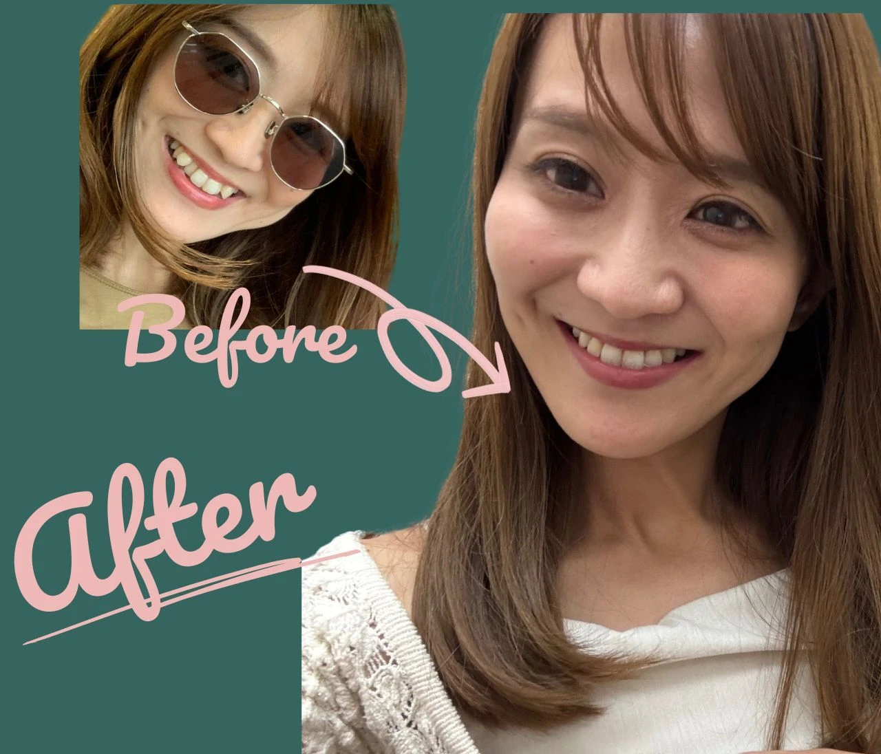 4年半で終わらず！【30代で始めた私の歯列矯正記録】