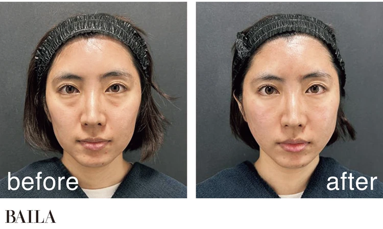 編集ぴらが実際に施術を受けてみた！