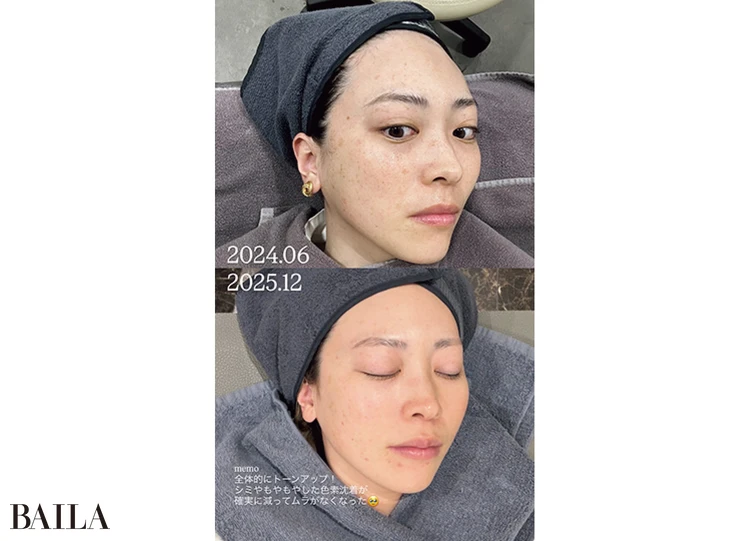 ハリ・キメ改善が期待できるジェネシスレーザーと、美白効果があるシンデレラ注射に夢中(31歳・映像制作)