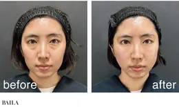 編集ぴらが実際に施術を受けてみた！